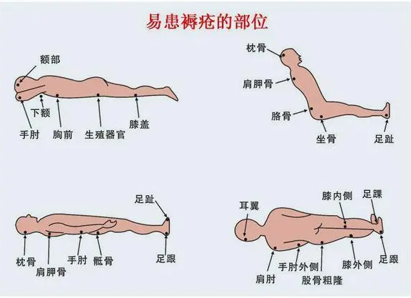 褥疮预防及护理